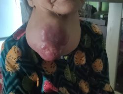 Sepuluh Tahun Diserang Penyalit Tumor Tiroit, Nenek Mawar Butuh Uluran Tangan Para Dermawan